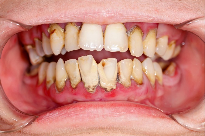 La parodontite, une inflammation des tissus de soutien de la dent qui peut entrainer d’autres maladies graves