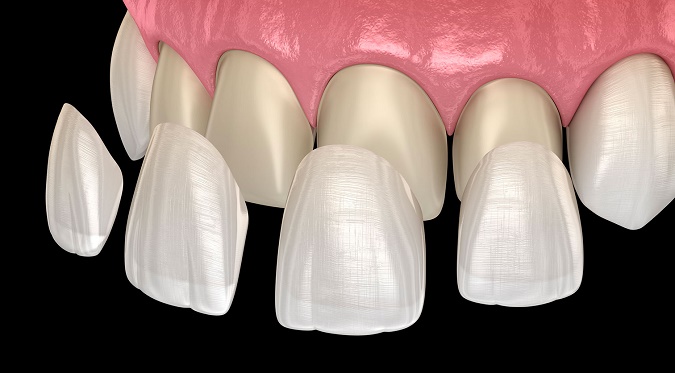 Facettes dentaires en Hongrie, prix, remboursement et nombre de rendez-vous nécessaire