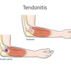 Aperçu sur 7 traitements de la tendinopathie