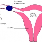 Qu'est-ce qu'une grossesse extra utérine?