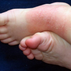 Tout savoir sur la dermatite atopique