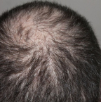 Comment faire face au problème de chute de cheveux ?