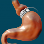 Anneau gastrique : une solution chirurgicale pour récupérer un régime de vie plus sain